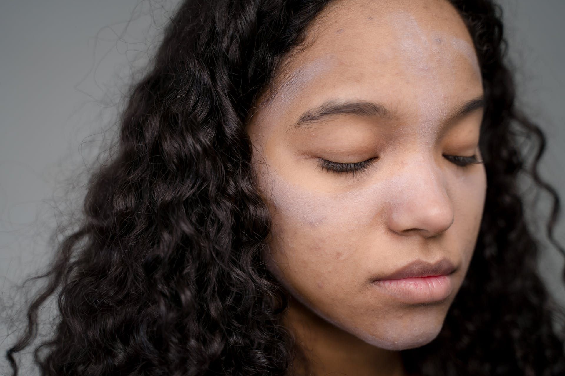 Fungal infections are caused by fungus. (Image via Pexels/Ron Lach)
